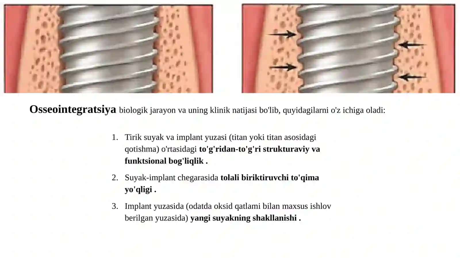 Tish implantati osteointegratsiya bosqichlari 3