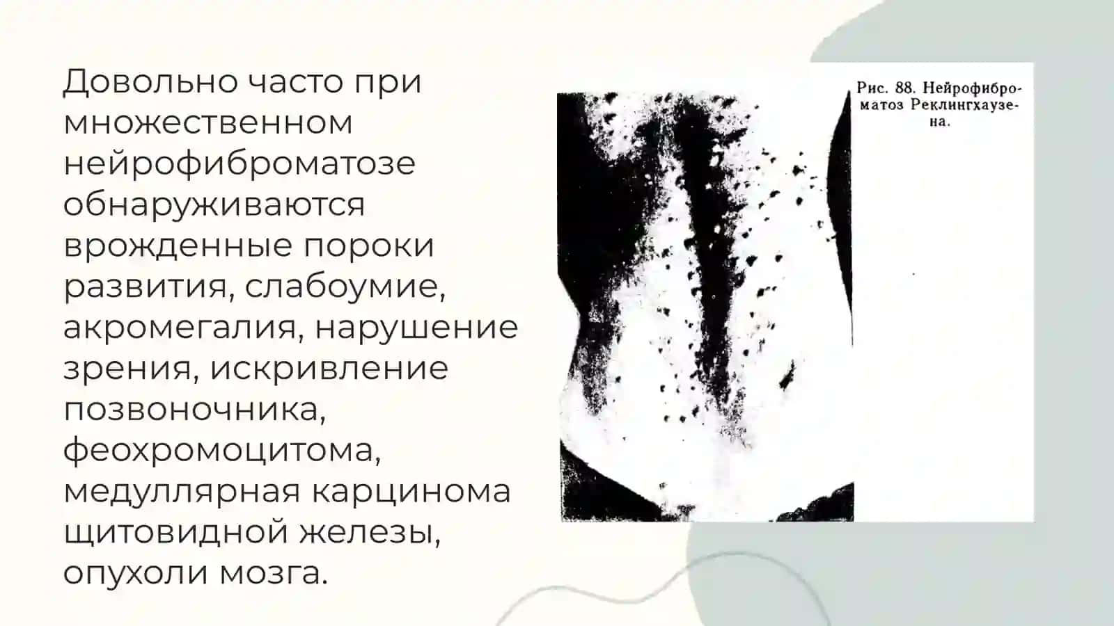 МНОЖЕСТВЕННЫЙ НЕЙРОФИБРОМАТОЗ 3