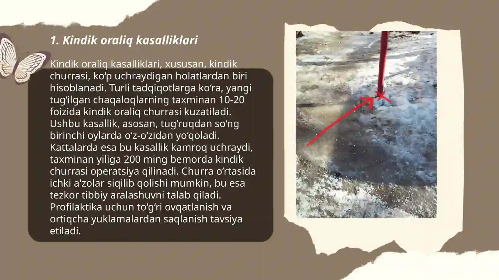 Bolalarda uchraydigan kindik oqmalari. Divertikul Mikkel 3