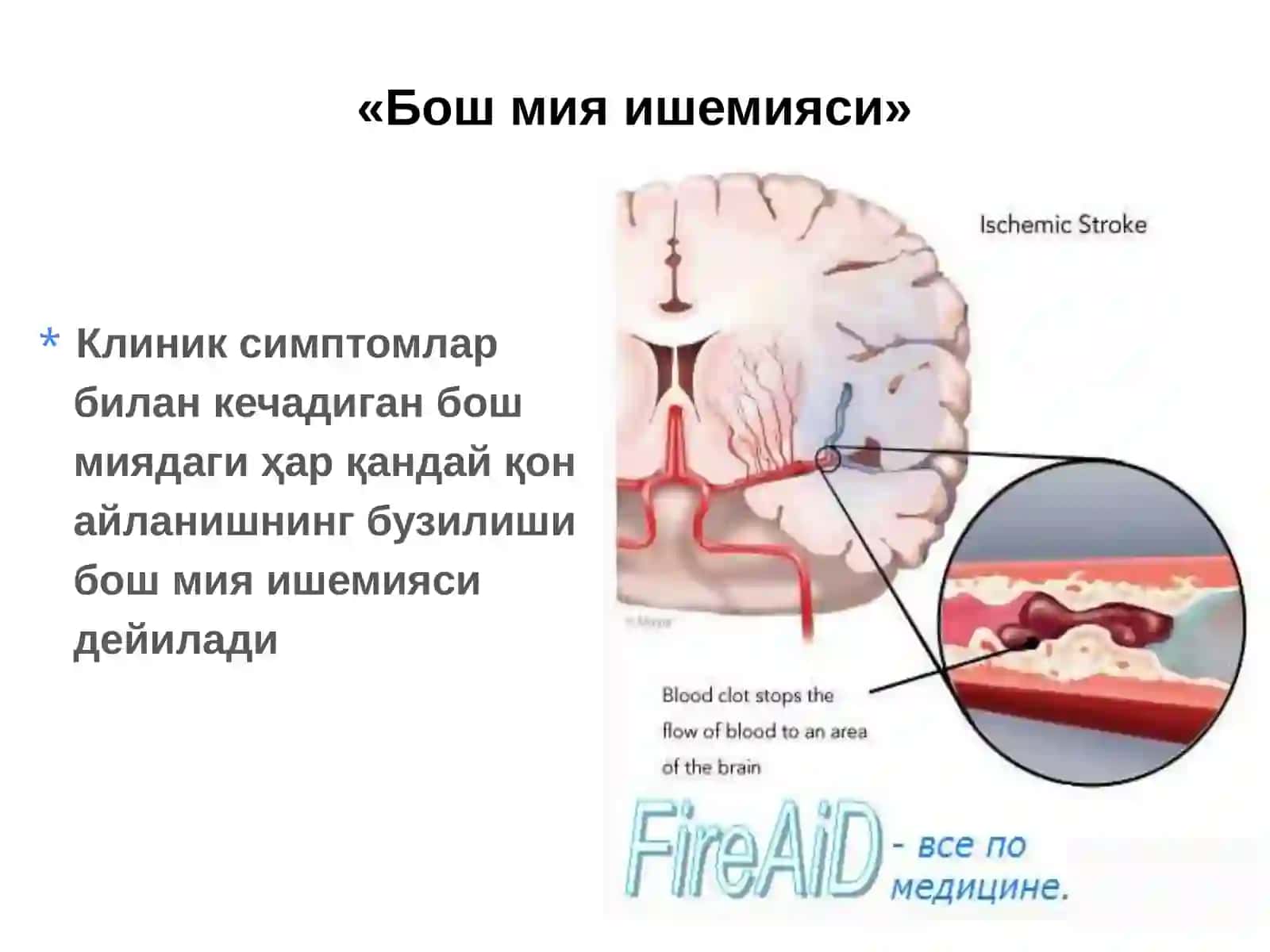 Ўткир мия ишемияси 3