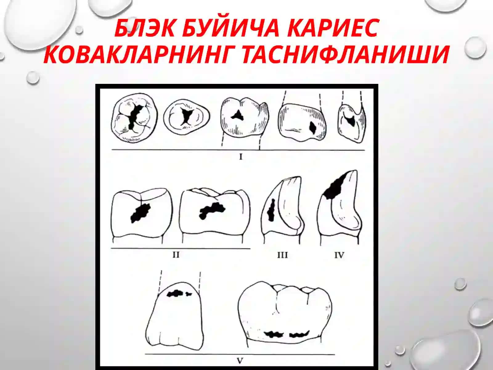 II синф кариоз бушликларини чархлаш ва пломбалаш 3