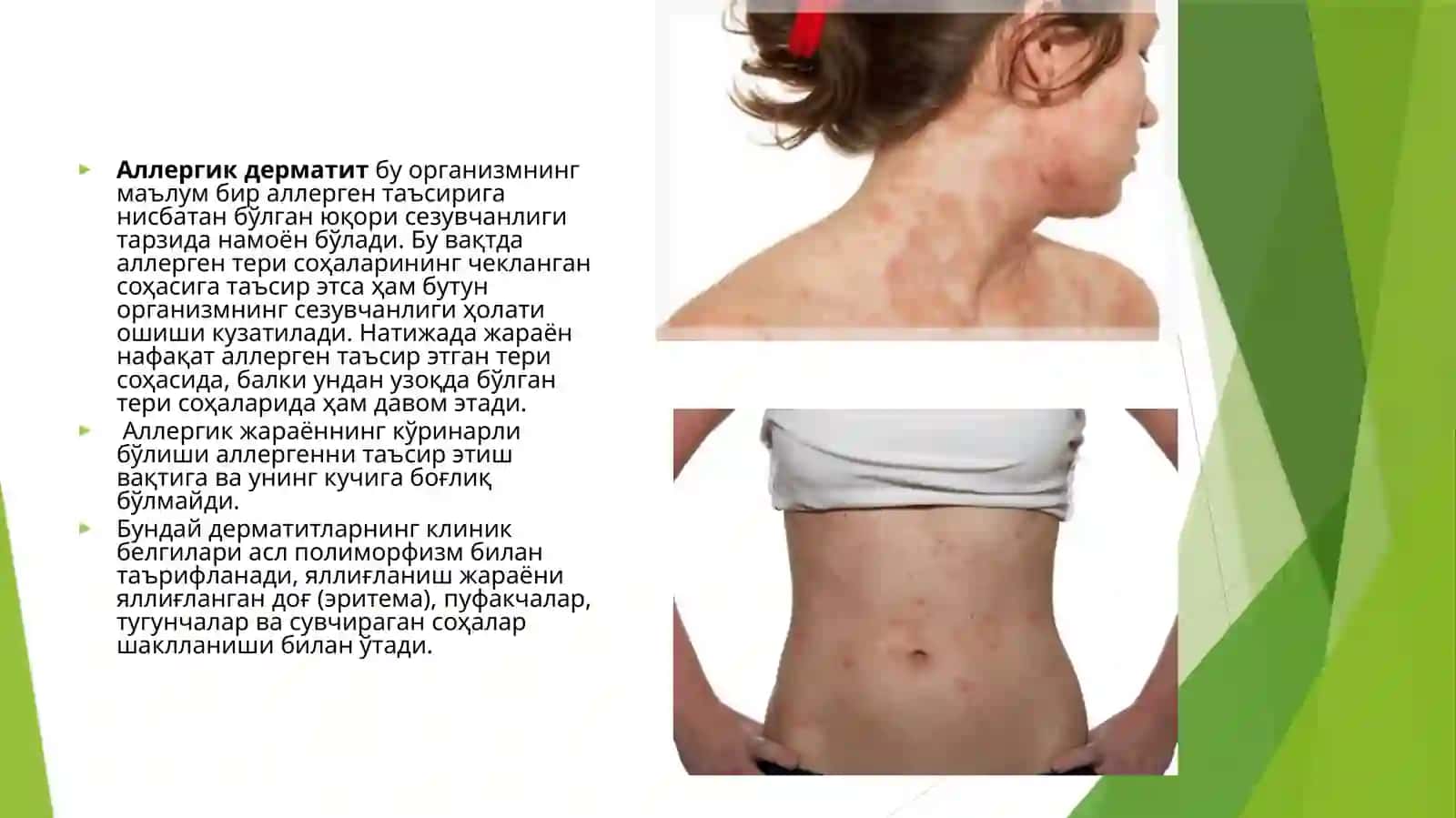Allergadermatoz 3