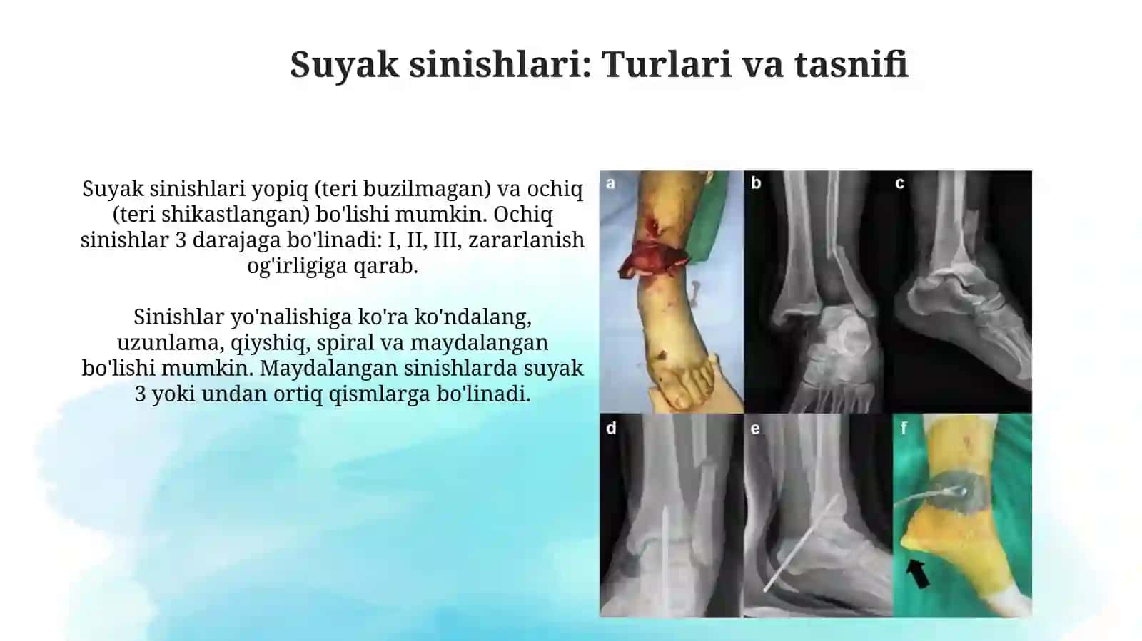 Suyaklar sinishi va boʻgʻimlar chiqishi.Transport immobilizatsiyatsiyasi.Yatrogeniya 3
