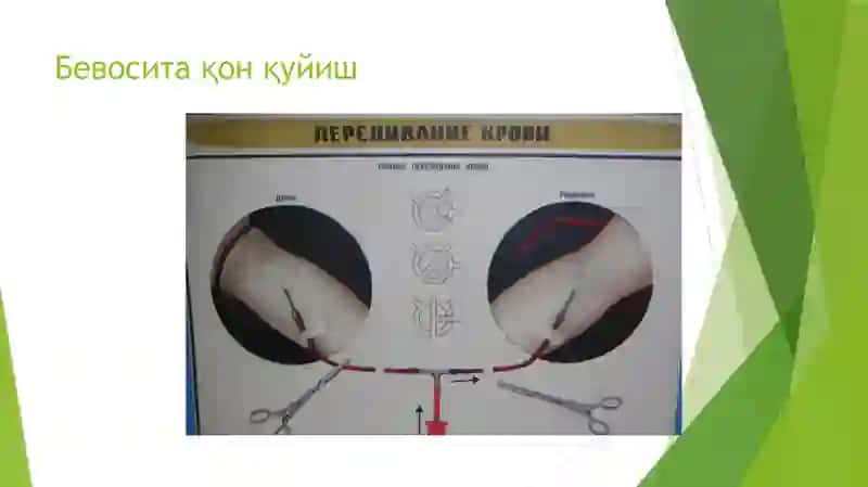 Qon quyish usullari 3