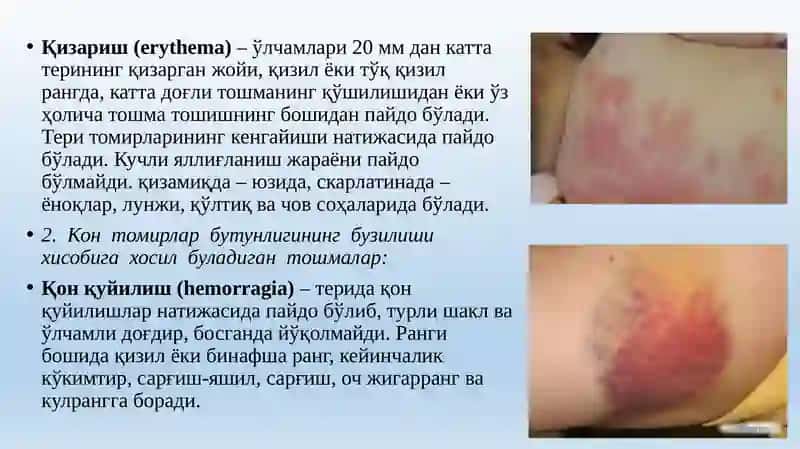 Розеола (rozeola) 3