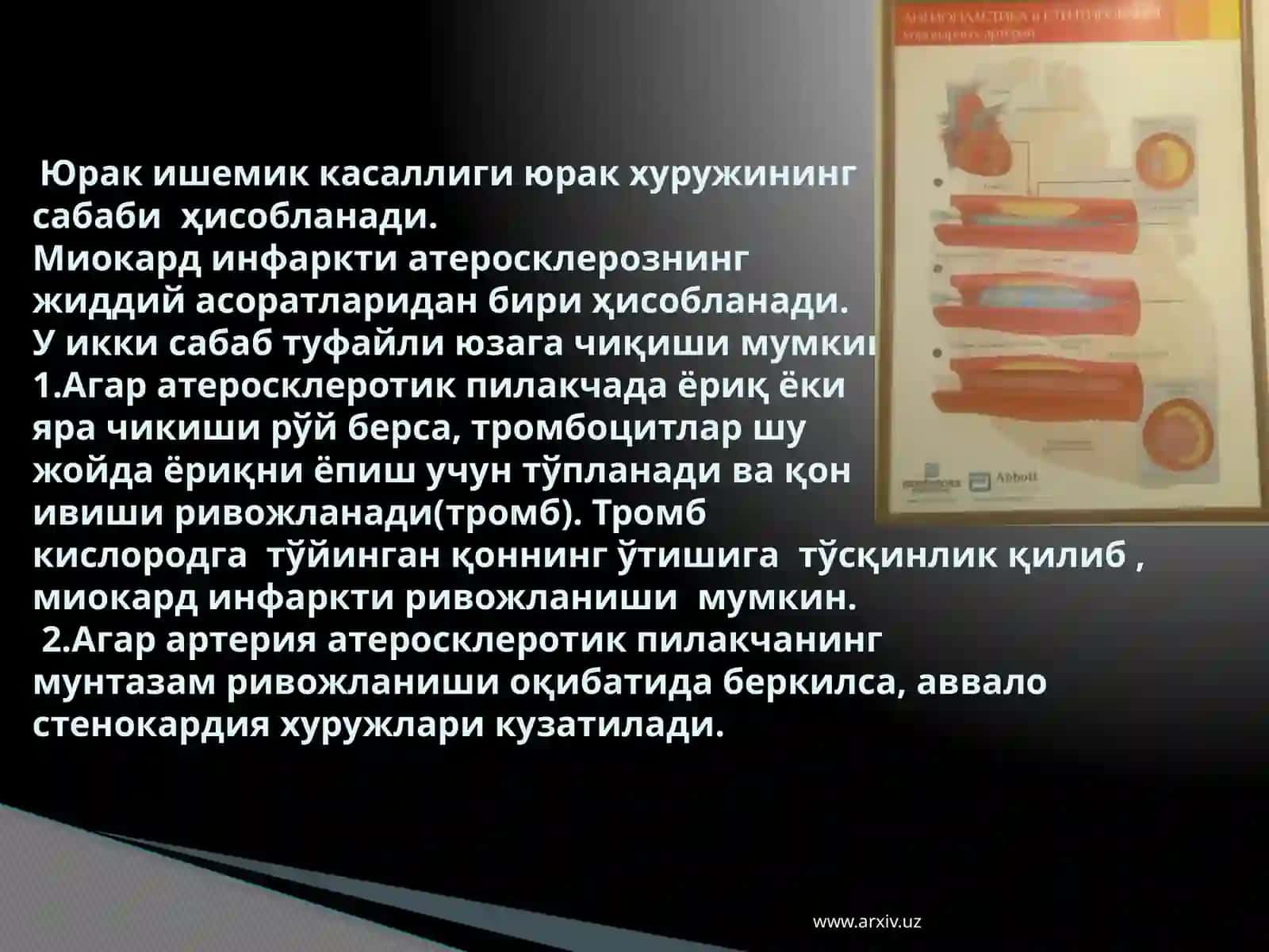 Ўткир коронар синдром 3