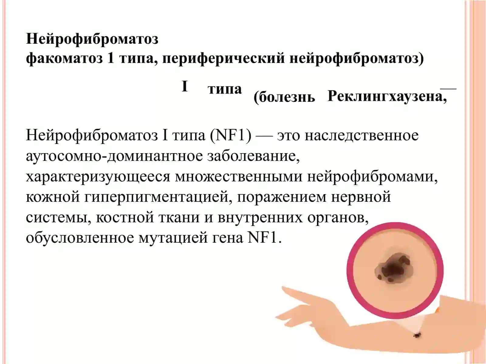 Нейрофиброматоз 1го типа 3