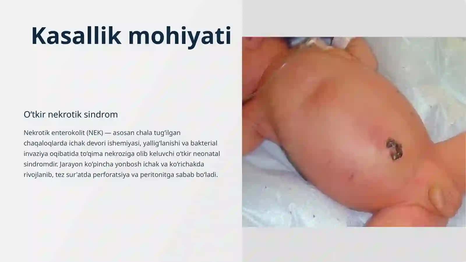 Chaqaloqlarda Nekrotik enterokolit 3