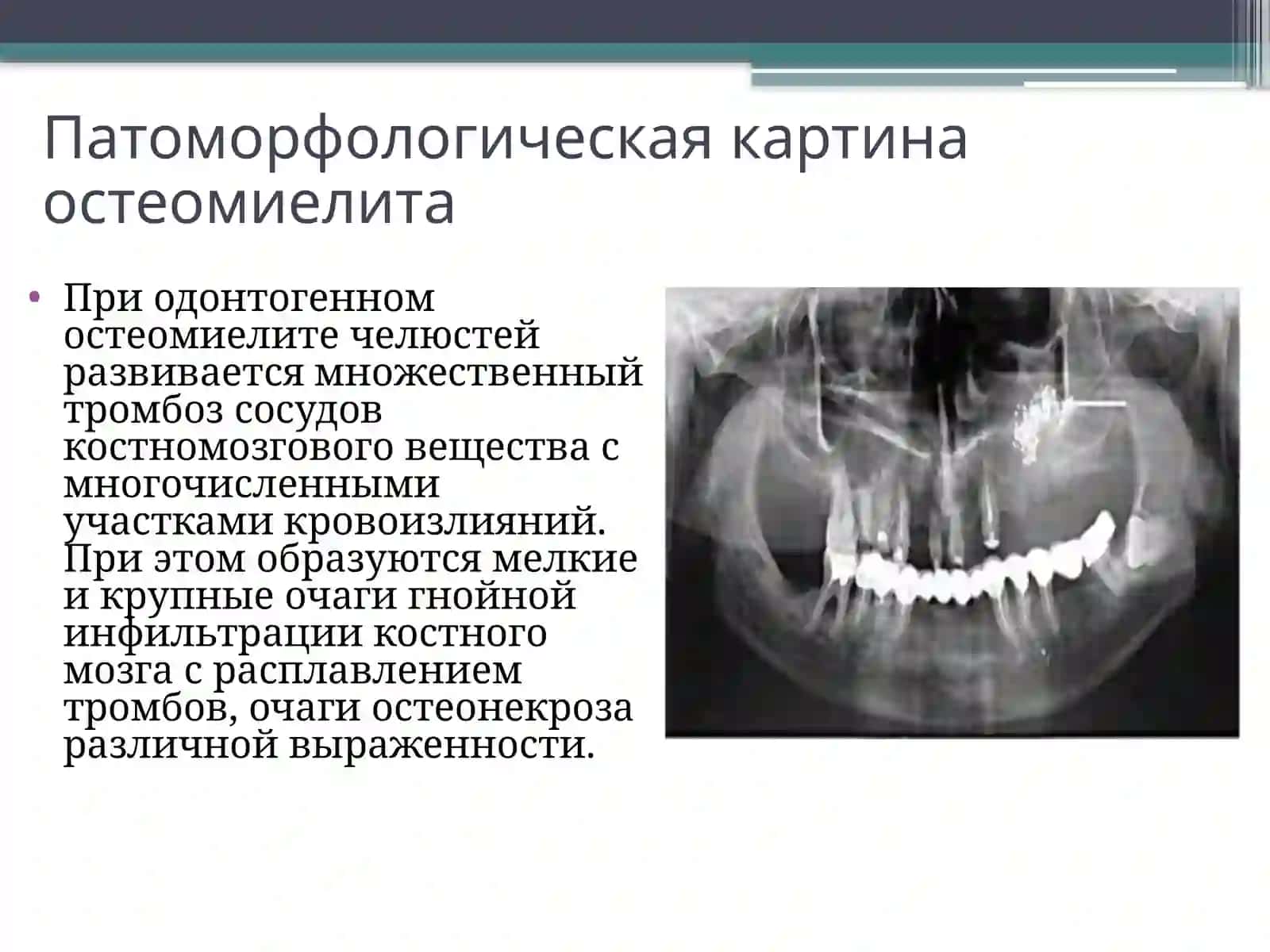 Одонтогенный остеомиелит челюсти 3
