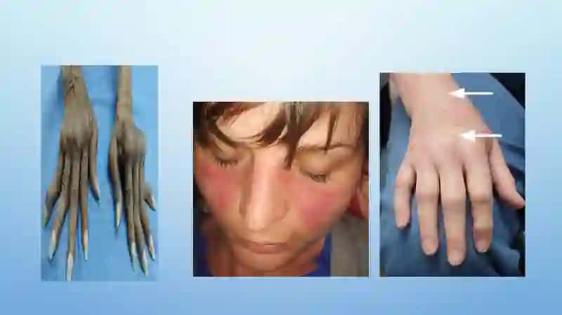 Bo‘g‘im sindromi. SKV, SSD va dermatomiozitni qiyosiy tashxislash. OSHtaktikasi 3