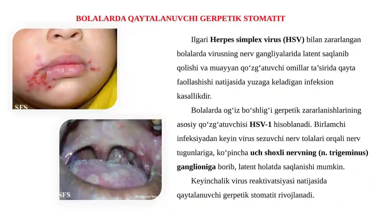 BOLALARDA QAYTALANUVCHI GERPETIK STOMATIT 3