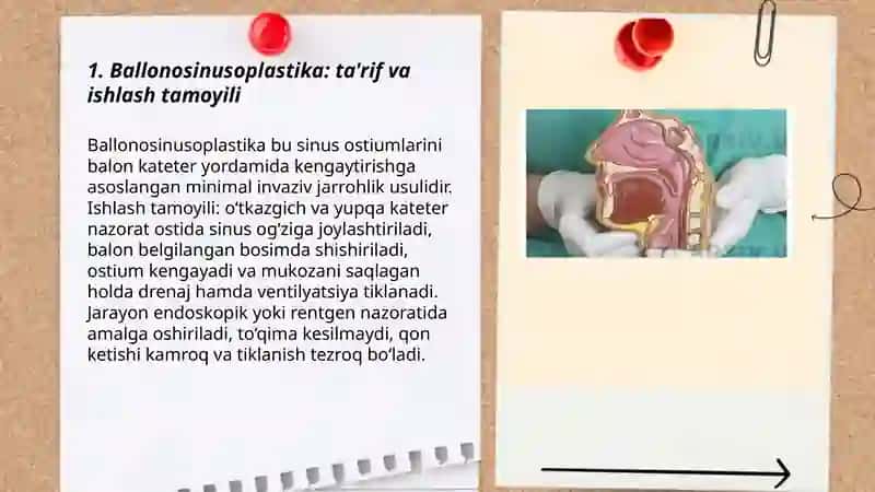 Ballonosinusoplastika 3