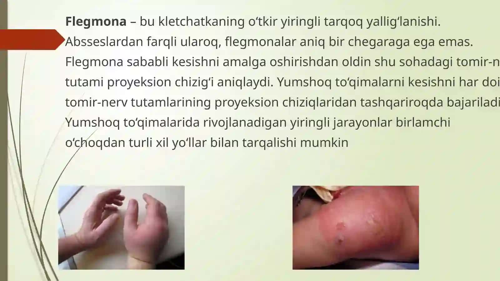 Subpektoral flegmonani ochish va drenajlash 3
