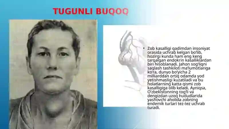 Zob kasalligi 3