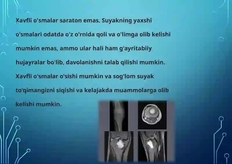 Suyak to'qimasi o'smalari 3
