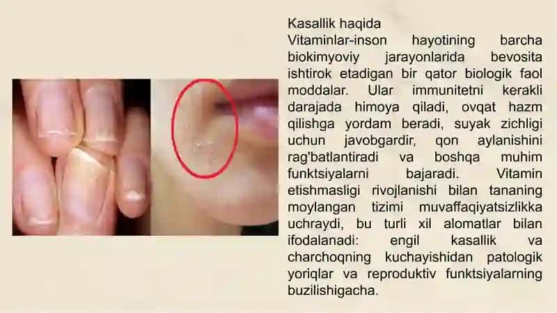 Avitaminoz va Gipovitaminoz 3