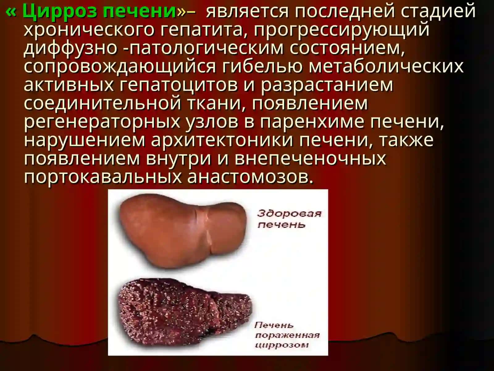 Современная лечебно  диагностическая тактика при циррозах печени 3
