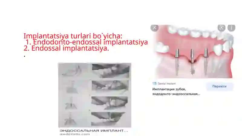 IMPLANTANTLAR TASNIFI, IMPLANTANTLAR TAYYORLASHDA QO’LLANILADIGAN MATERIALLAR 3