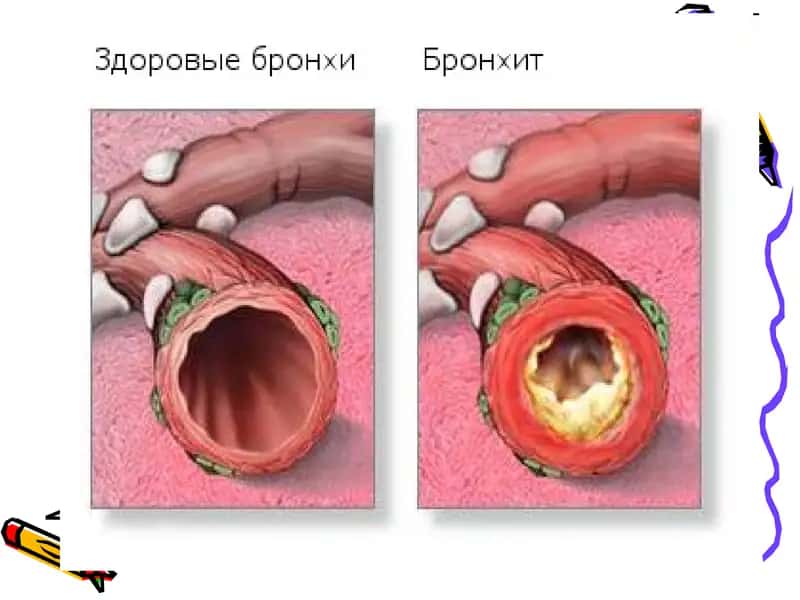 Болаларда Бронхитлар 3