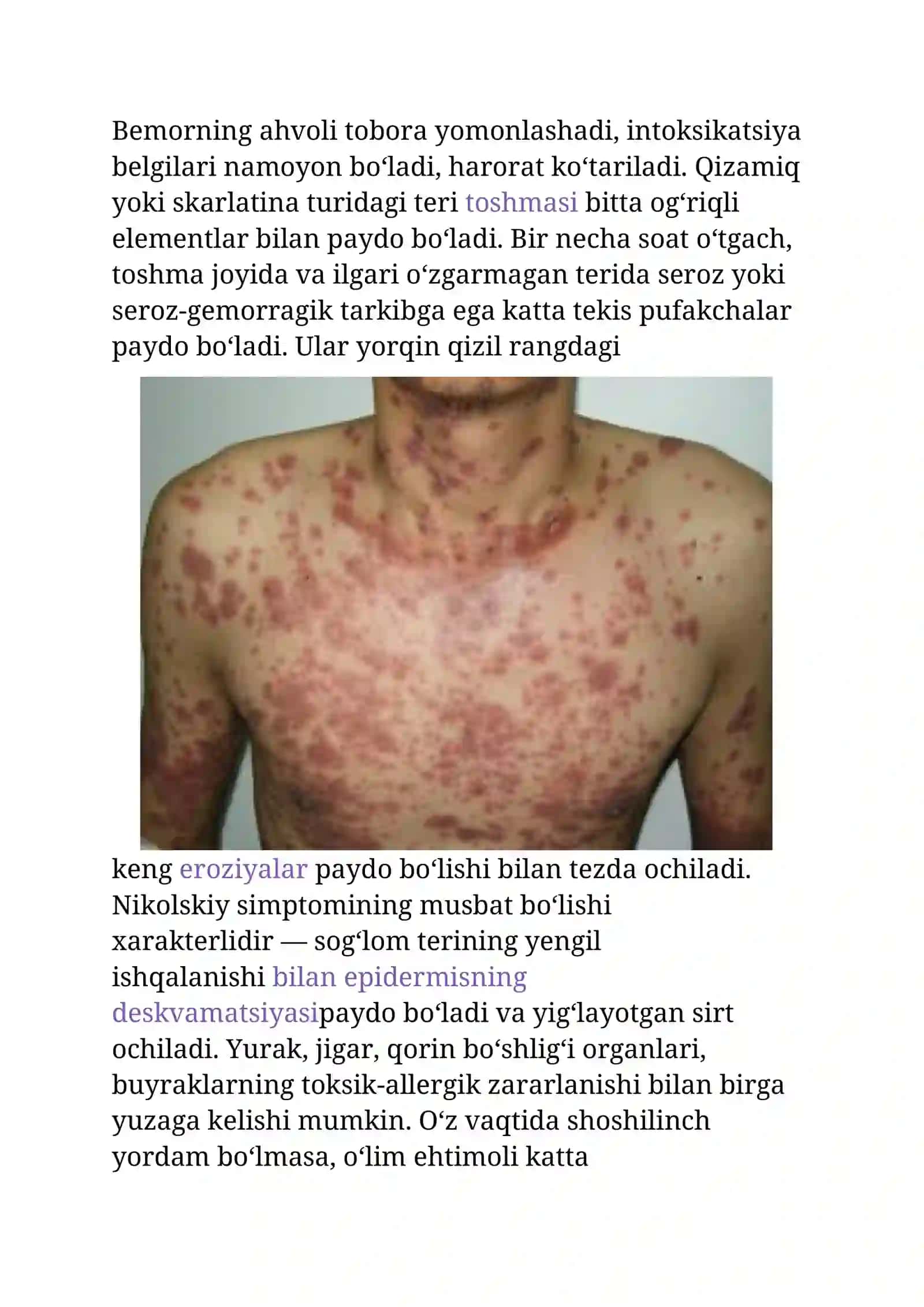 Layella sindromi 3
