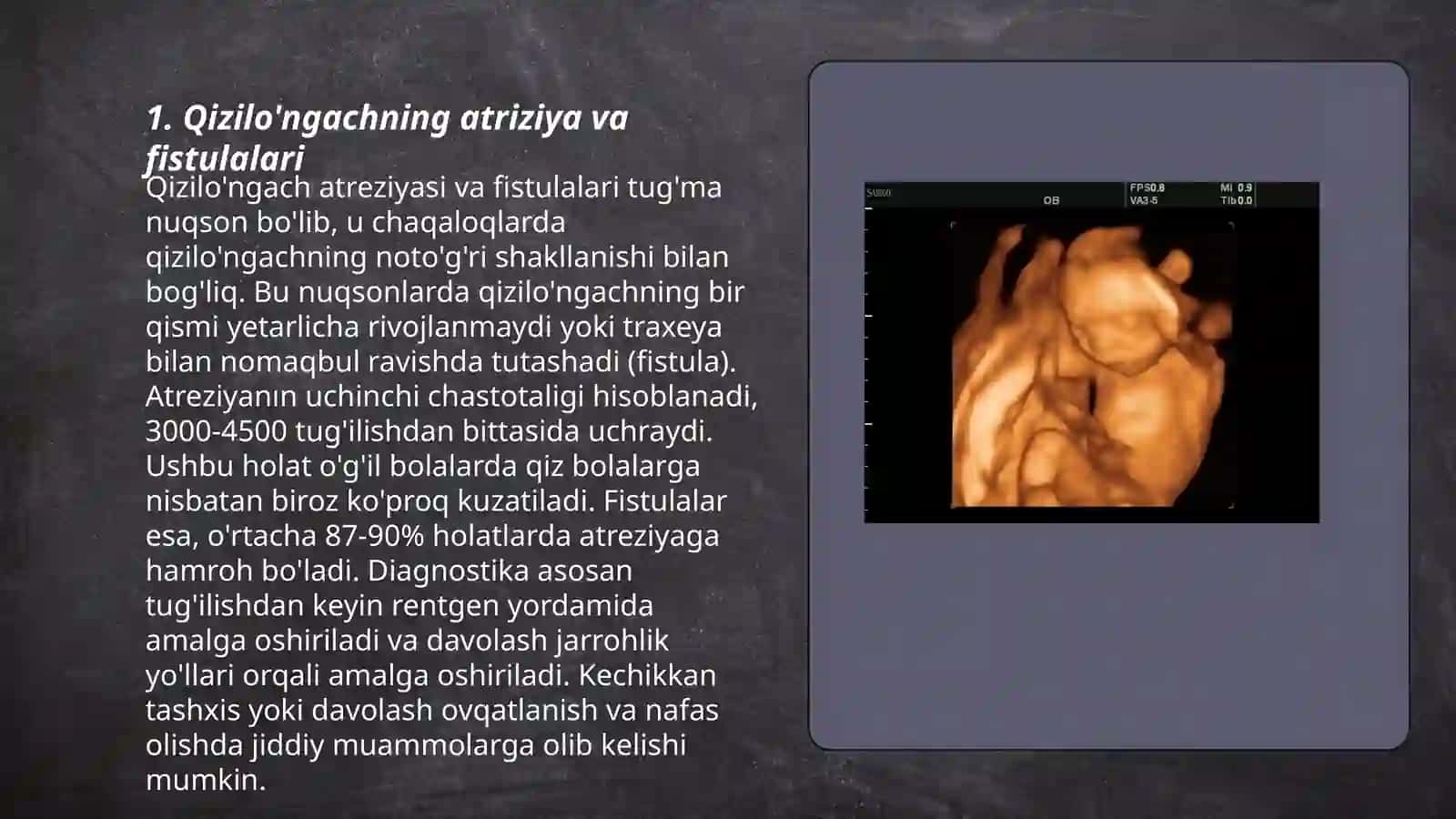 Qizilo'ngachning tugʻma va orttirilgan nuqsonlari xirurgiyasi 3