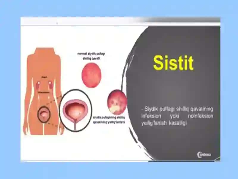 Bolalardagi siydik yo‘llari infeksiyalari 3
