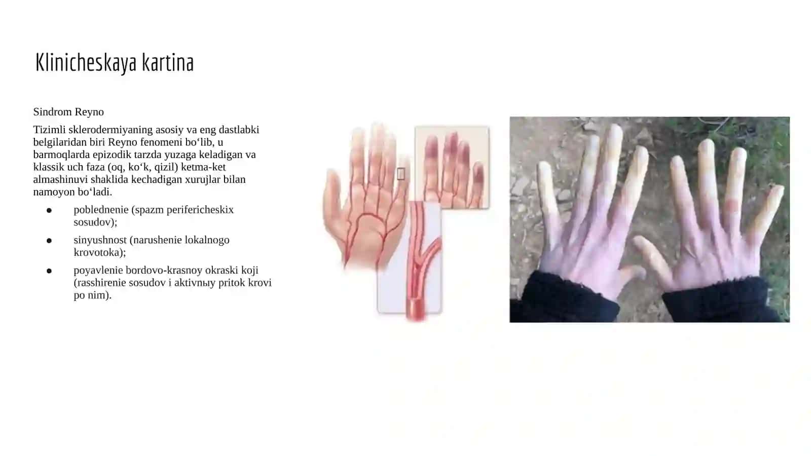 Tizimli sklerodermiya (1-variant) 3