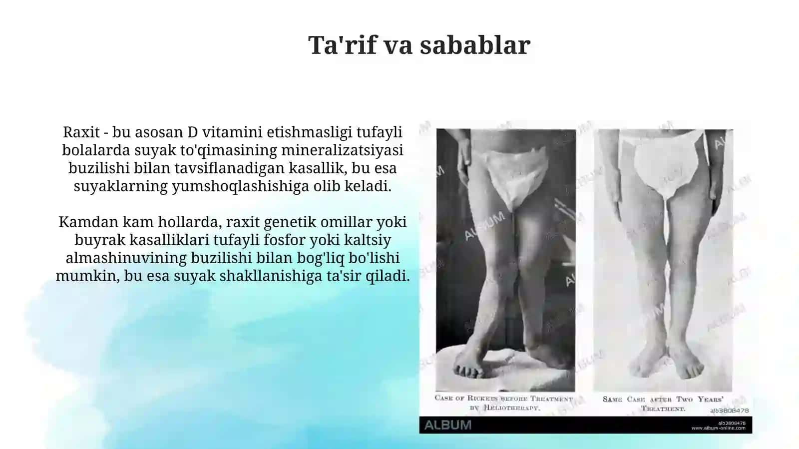 Raxitsimon kasalliklar 3