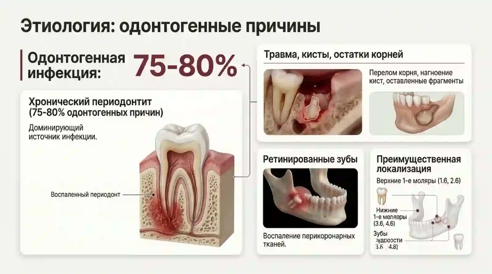 Периостит челюстий 3