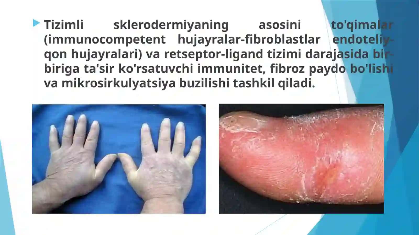 Tizimli sklerodermiya( systemic sclerosis, systemic dermatosis) 3