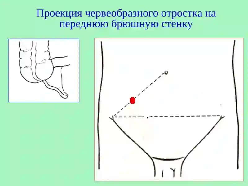 Острый аппендицит 3