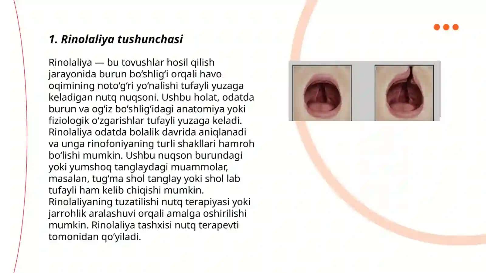 Rinolaliyani o‘rganish tarixidan qisqacha ma'lumotlar va rinolalik bolalarga ko‘rsatiladigan logopedik yordam 3