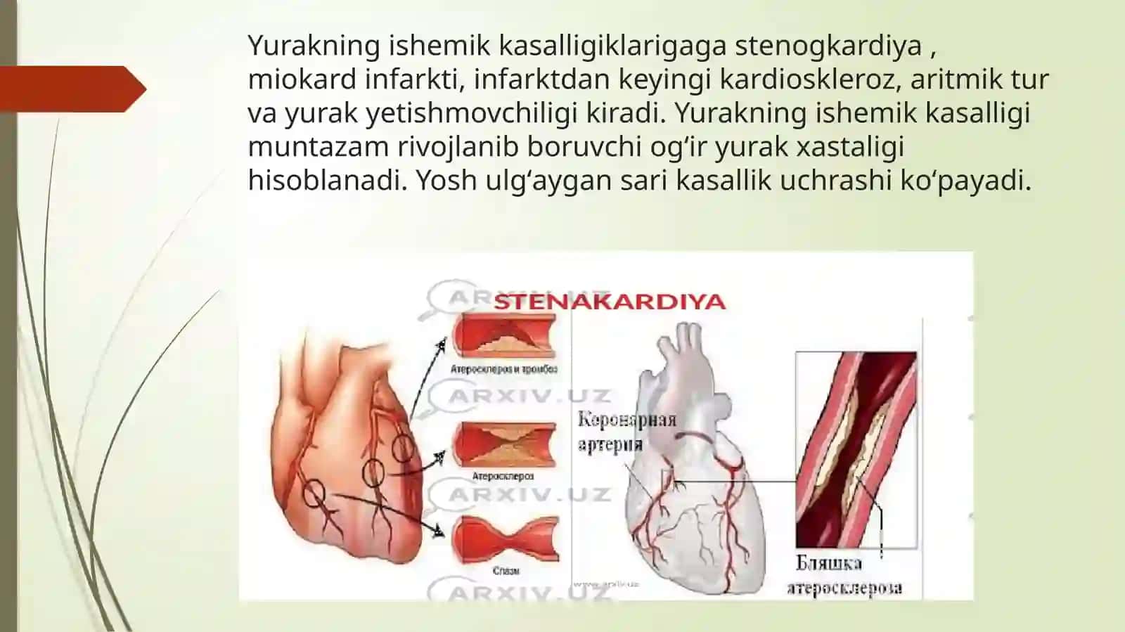 юрак ишемик касалликлари. инфаркт 3