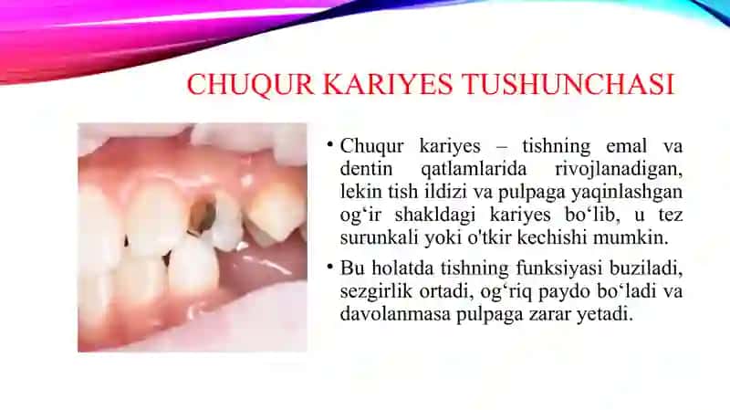 Chuqur kariyes. O'tkir va surunkali shakllarini klinik kechishi, tashxislash, qiyosiy tashxisi. Fizikaviy tekshirish usullari (termo-elektroodontodiagnostika). Kasallik tarixini yozish. 3
