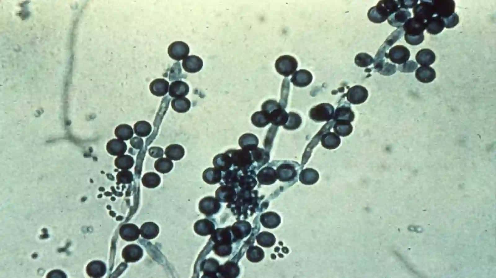 Zamburug'infeksiyalari(kandidoz,aspergilez) 3