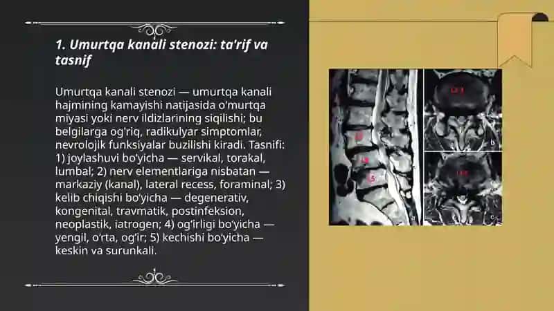 Umurtqa Kanali Stenoz 3