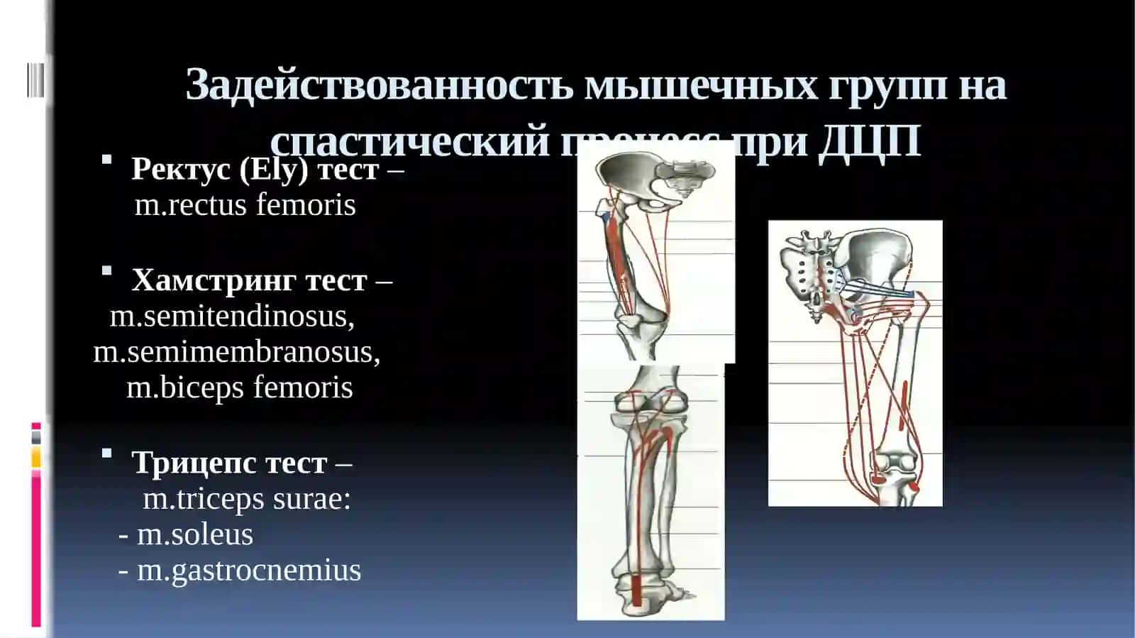 Ортопедические аспекты детского церебрального паралича 3