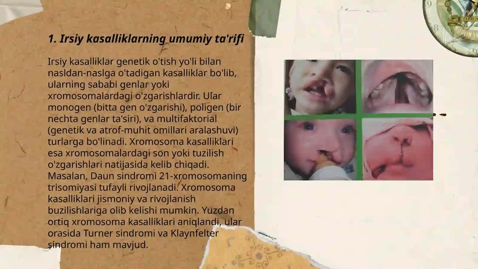 Irsiy kasalliklar. Irsiy kasalliklar klasifikasiyasi. Xromosoma kasalliklari 3