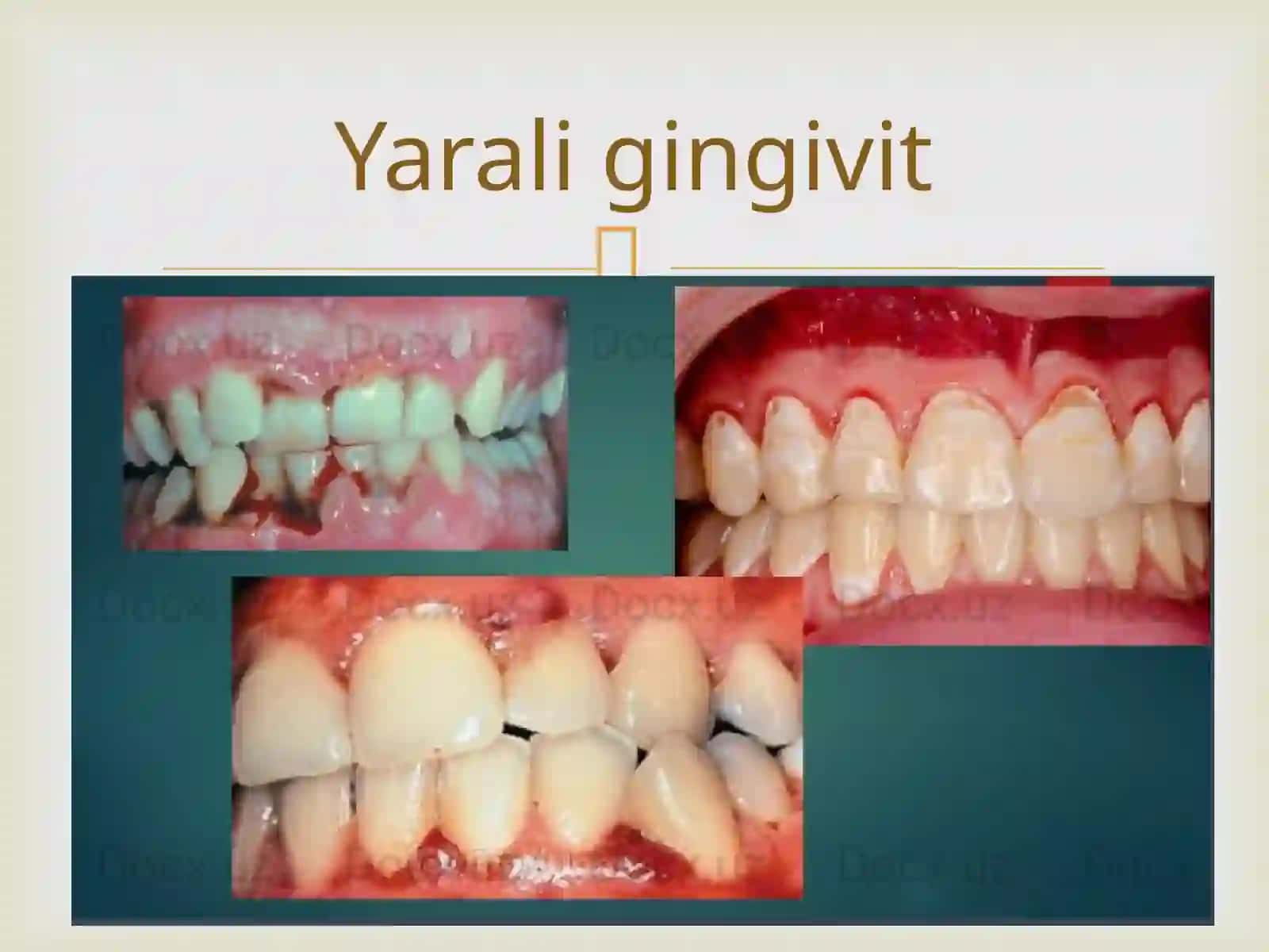 Yarali gingivit. Klinikasi,diagnostikasi. 3