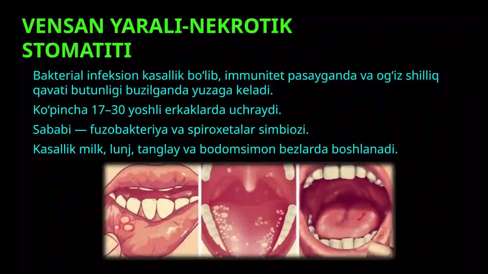 VENSAN YARALI-NEKROTIK STOMATITI 3