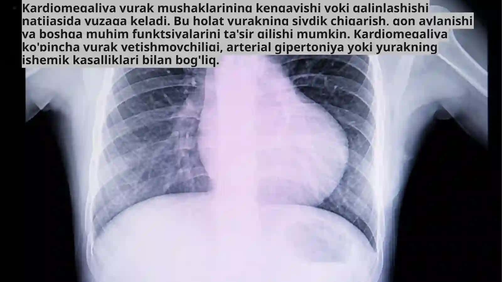 Kardiomegaliya 3