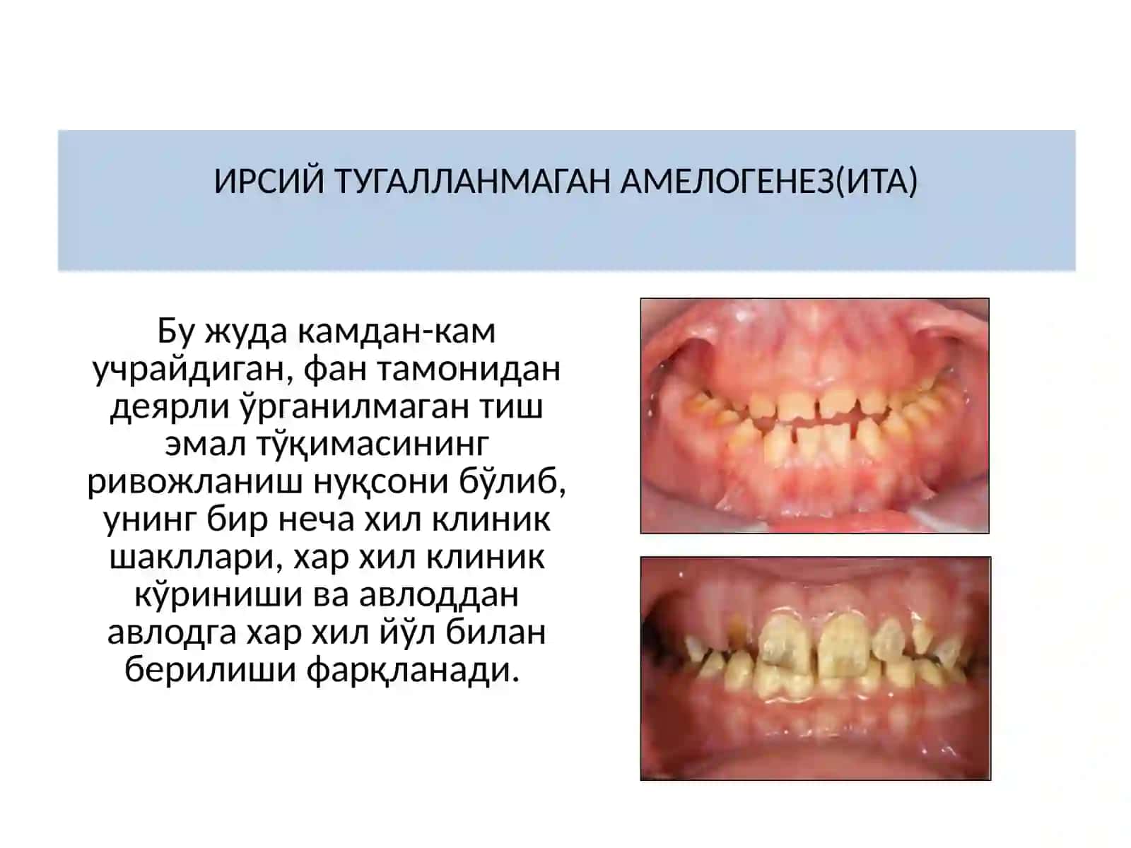 ИРСИЙ ТУГАЛЛАНМАГАН АМЕЛОГЕНЕЗ(ИТА) 3
