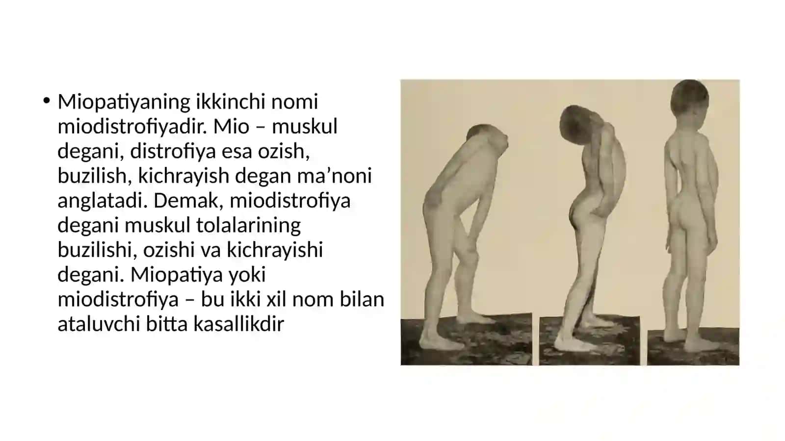 Miopatiyalar. Mushak denervatsiyasi 3