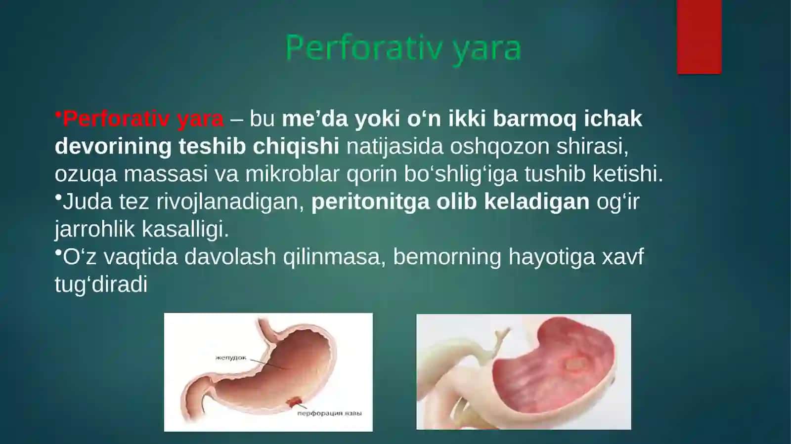 O‘tkirqorinni stimullovchi kasalliklar 3