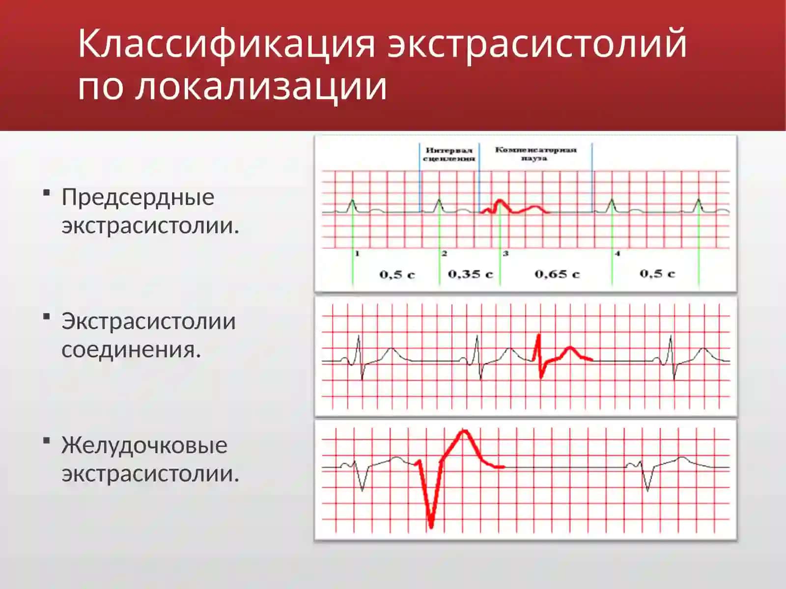 Экстрасистолия 3