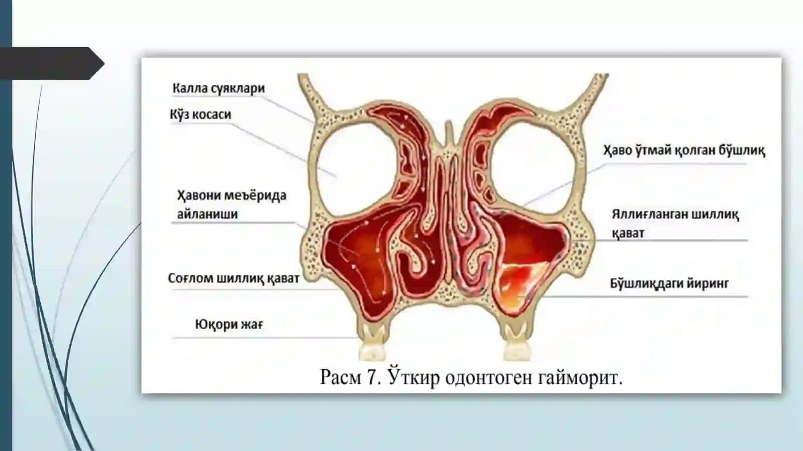 Gaymorit klassifikatsiyasi.Gaymorit bo'lganda uni jarrohlik yo'li bilan davolash. 3