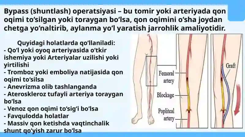 Qo‘l va oyoq qon tomirlarda bajariladigan zamonaviy rekonstruktiv operatsiyalar turlari va texnikasi 3