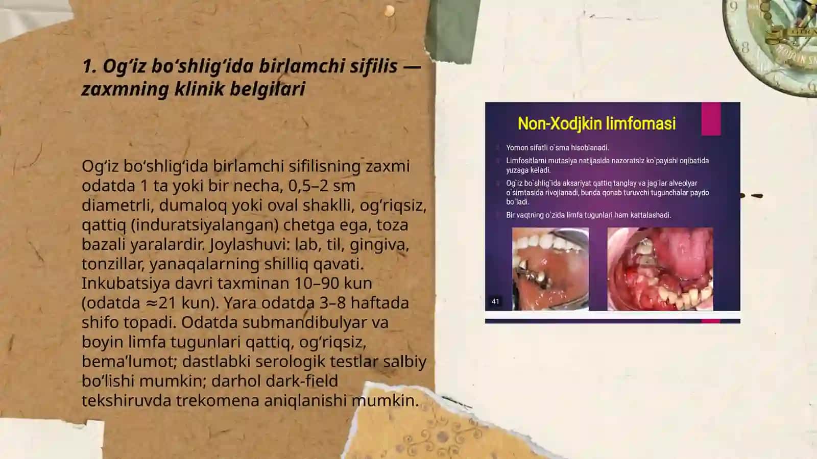 Ogʻiz boʻshligʻida birlamchi sifilis — zaxmning klinik belgilari 3