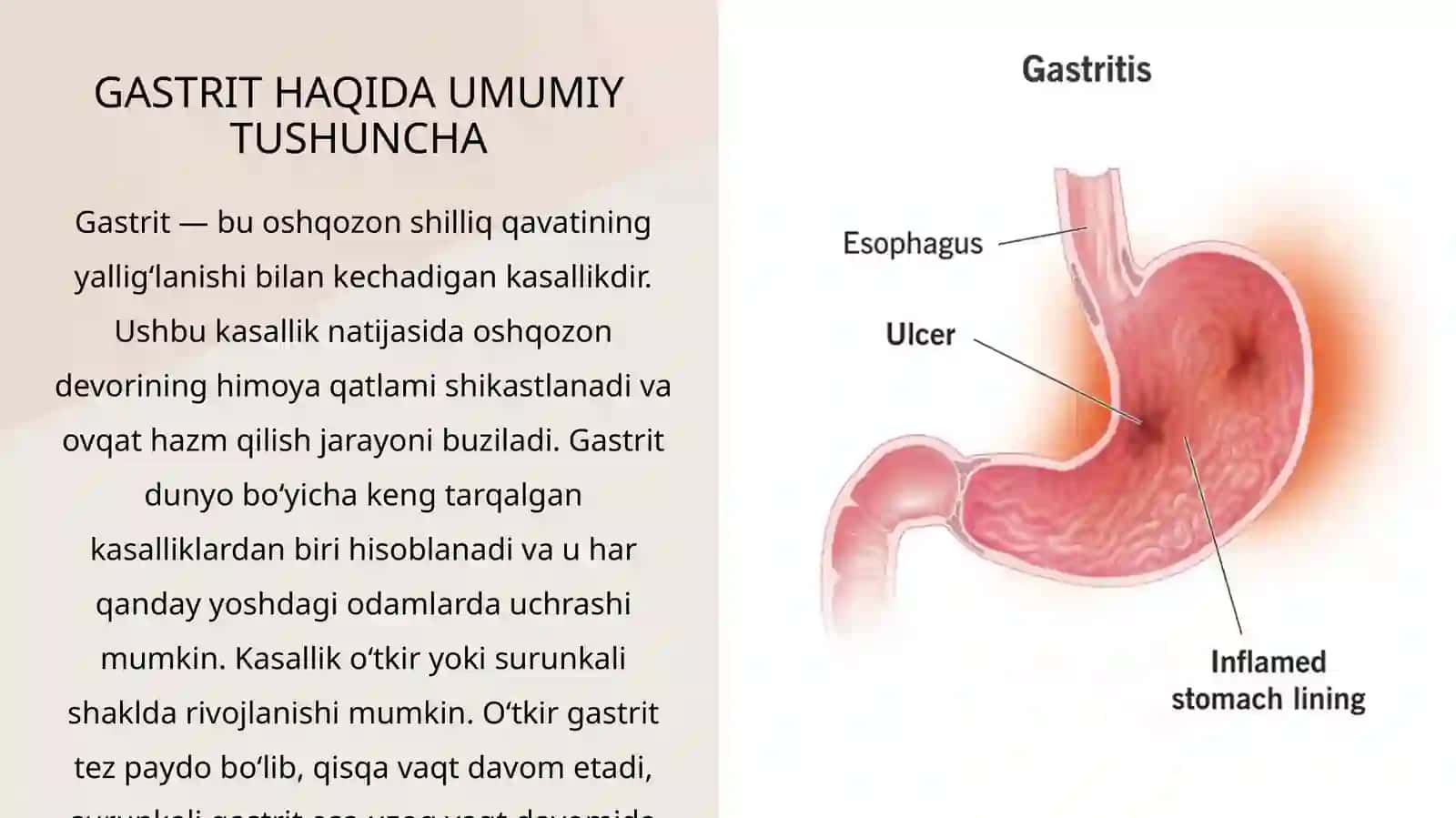 GASTRIT KASALLIGI 3