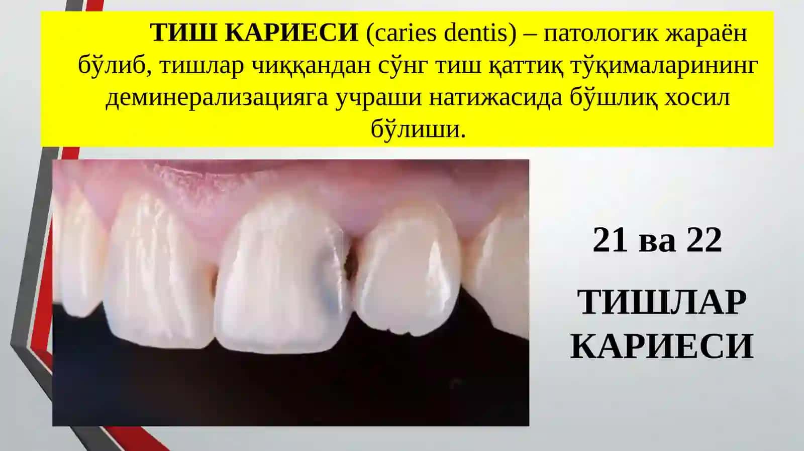 Тиш Кариеси 3